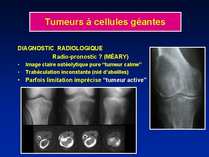 Tumeurs à cellules géantes DIAGNOSTIC RADIOLOGIQUE Radio-pronostic ? (MÉARY) • • Image claire ostéolytique