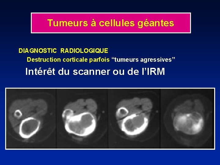 Tumeurs à cellules géantes DIAGNOSTIC RADIOLOGIQUE Destruction corticale parfois “tumeurs agressives” Intérêt du scanner