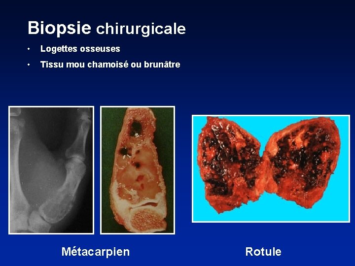 Biopsie chirurgicale • Logettes osseuses • Tissu mou chamoisé ou brunâtre Métacarpien Rotule 