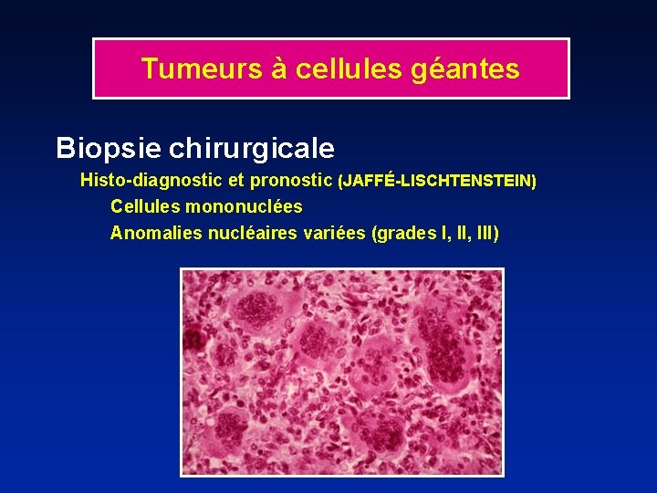 Tumeurs à cellules géantes Biopsie chirurgicale Histo-diagnostic et pronostic (JAFFÉ-LISCHTENSTEIN) Cellules mononuclées Anomalies nucléaires