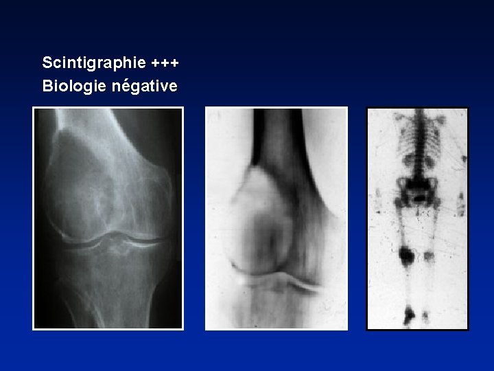 Scintigraphie +++ Biologie négative 