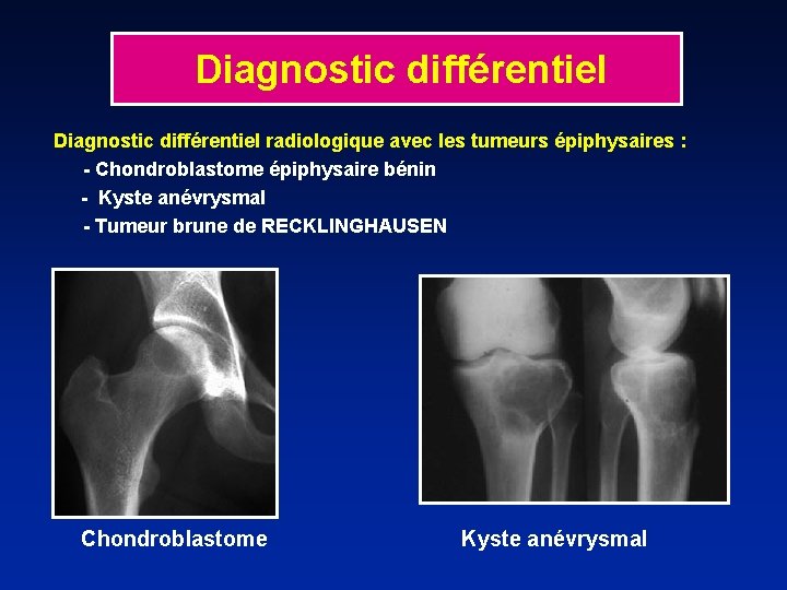 Diagnostic différentiel radiologique avec les tumeurs épiphysaires : - Chondroblastome épiphysaire bénin - Kyste