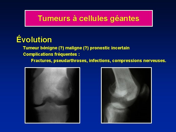 Tumeurs à cellules géantes Évolution Tumeur bénigne (? ) maligne (? ) pronostic incertain