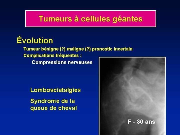 Tumeurs à cellules géantes Évolution Tumeur bénigne (? ) maligne (? ) pronostic incertain