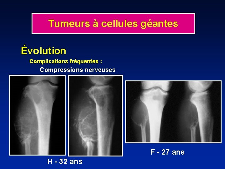 Tumeurs à cellules géantes Évolution Complications fréquentes : Compressions nerveuses F - 27 ans