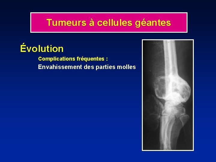 Tumeurs à cellules géantes Évolution Complications fréquentes : Envahissement des parties molles 