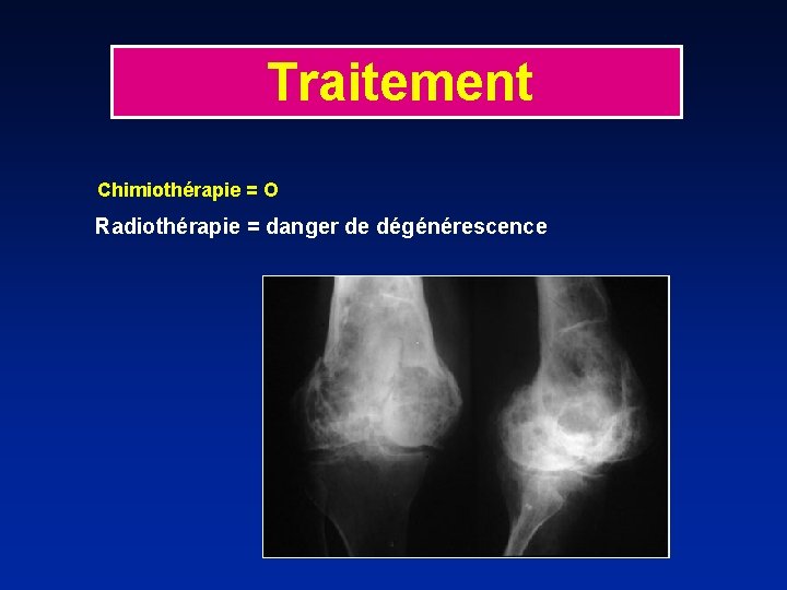 Traitement Chimiothérapie = O Radiothérapie = danger de dégénérescence 