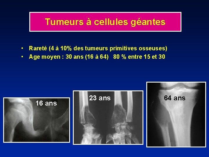 Tumeurs à cellules géantes • Rareté (4 à 10% des tumeurs primitives osseuses) •