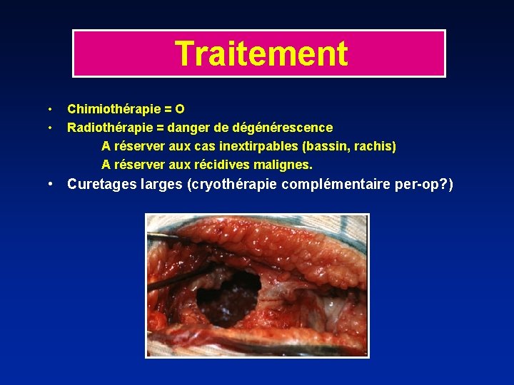 Traitement • • Chimiothérapie = O Radiothérapie = danger de dégénérescence A réserver aux