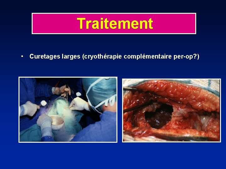 Traitement • Curetages larges (cryothérapie complémentaire per-op? ) 