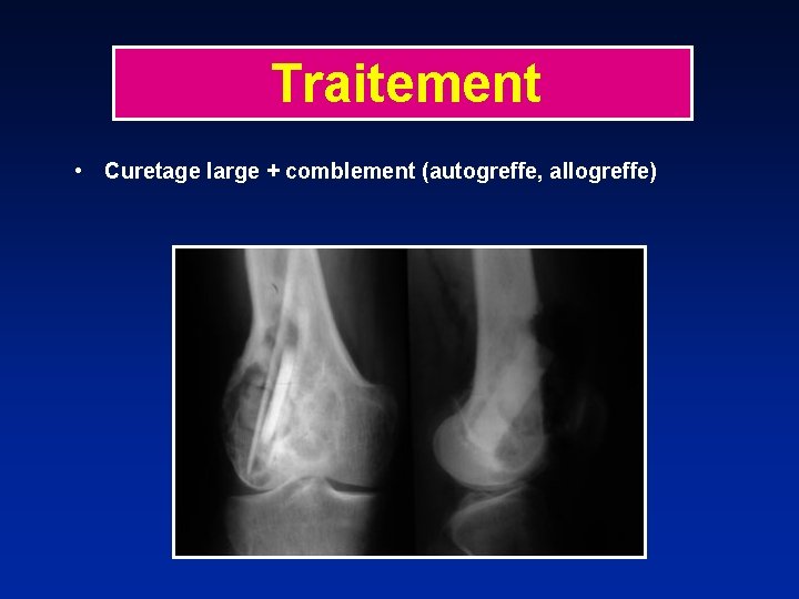 Traitement • Curetage large + comblement (autogreffe, allogreffe) 
