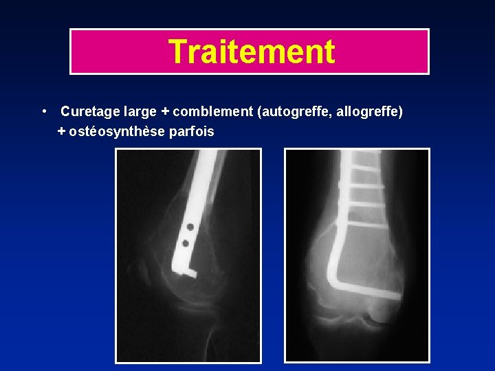 Traitement • Curetage large + comblement (autogreffe, allogreffe) + ostéosynthèse parfois 