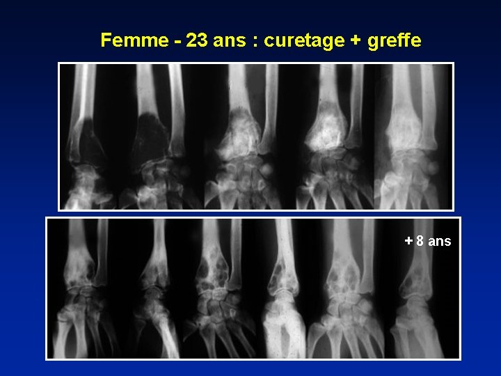 Femme - 23 ans : curetage + greffe + 8 ans 