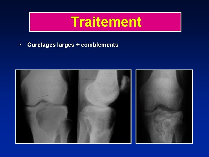 Traitement • Curetages larges + comblements 