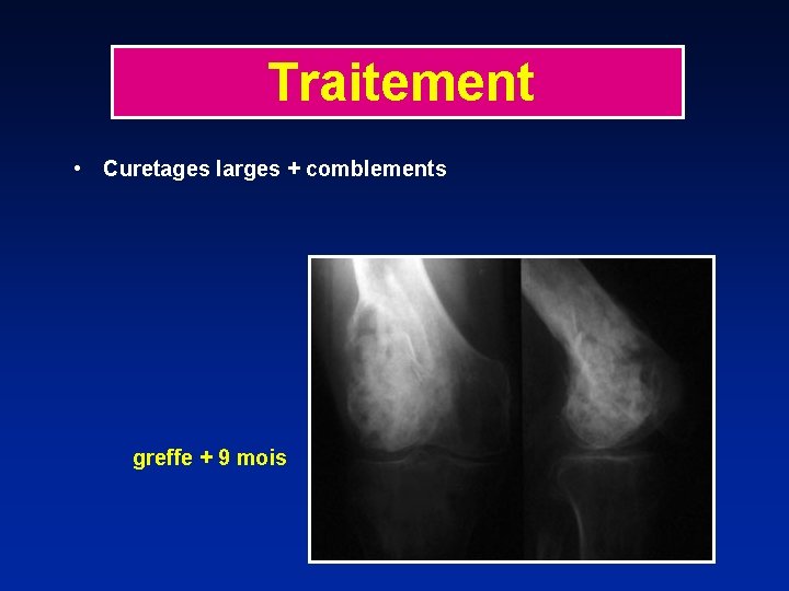 Traitement • Curetages larges + comblements greffe + 9 mois 