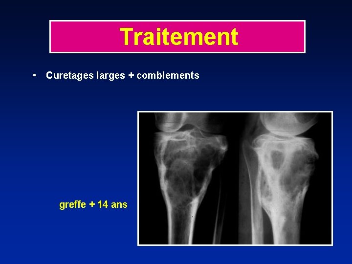 Traitement • Curetages larges + comblements greffe + 14 ans 