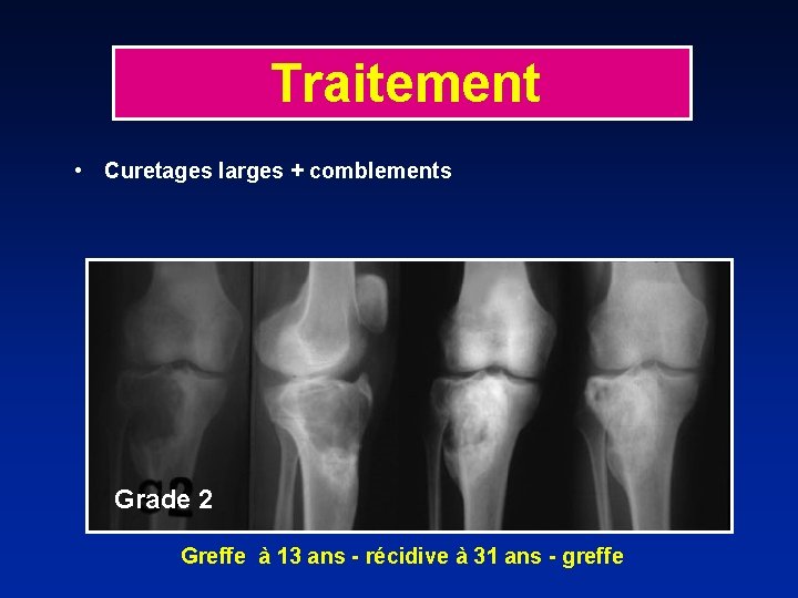 Traitement • Curetages larges + comblements Grade 2 Greffe à 13 ans - récidive