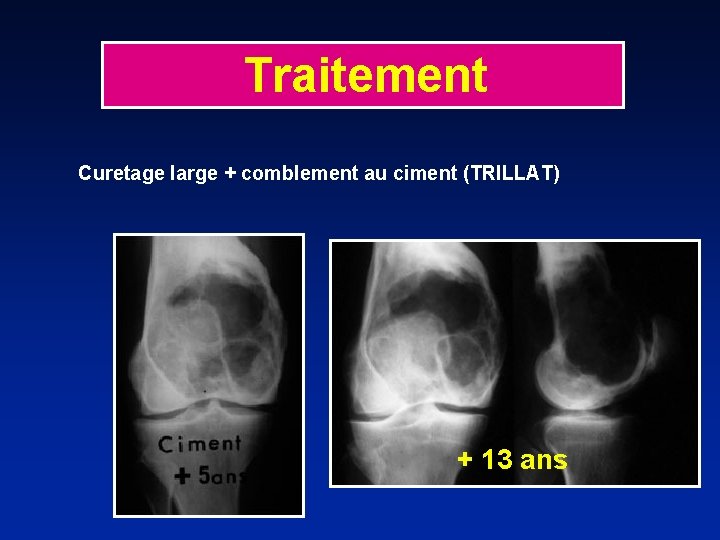 Traitement Curetage large + comblement au ciment (TRILLAT) + 13 ans 