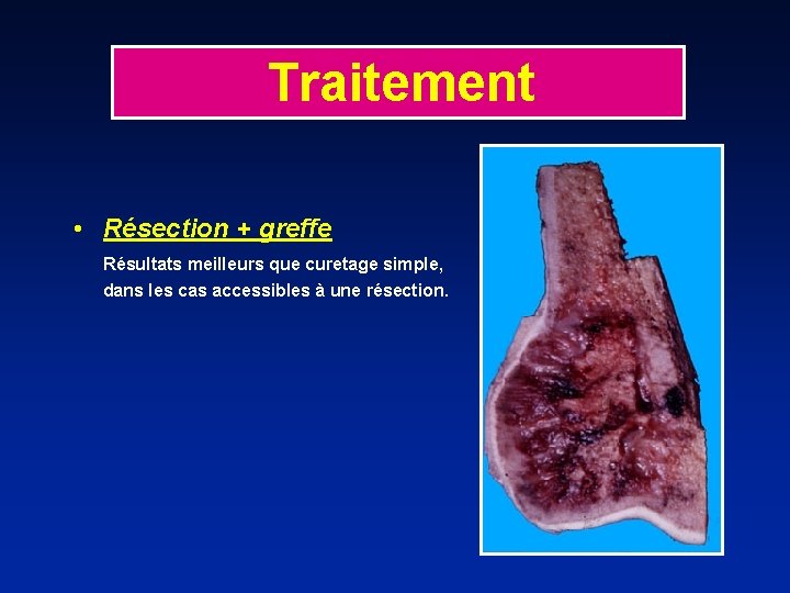 Traitement • Résection + greffe Résultats meilleurs que curetage simple, dans les cas accessibles