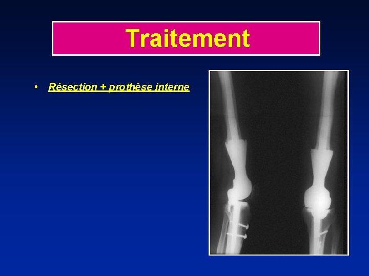 Traitement • Résection + prothèse interne 