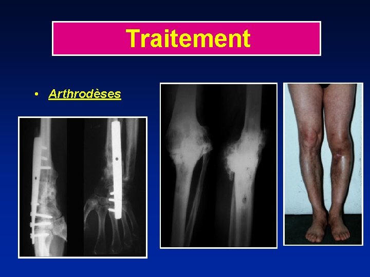 Traitement • Arthrodèses 