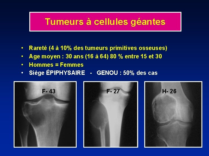 Tumeurs à cellules géantes • • Rareté (4 à 10% des tumeurs primitives osseuses)