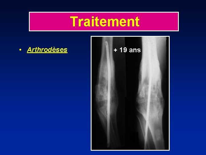 Traitement • Arthrodèses + 19 ans 