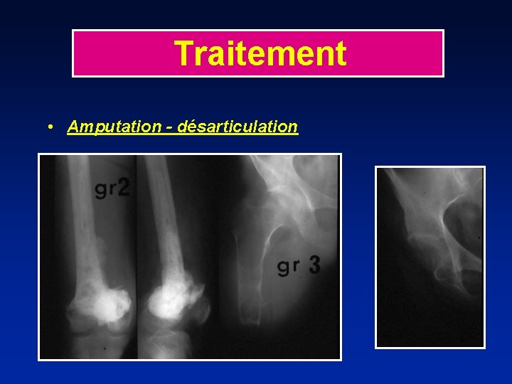 Traitement • Amputation - désarticulation 