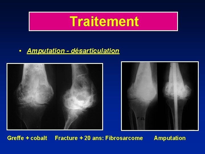 Traitement • Amputation - désarticulation Greffe + cobalt Fracture + 20 ans: Fibrosarcome Amputation