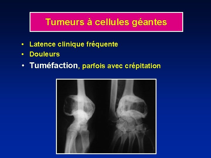 Tumeurs à cellules géantes • Latence clinique fréquente • Douleurs • Tuméfaction, parfois avec