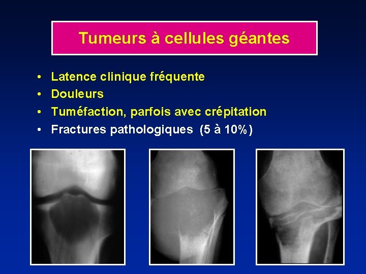 Tumeurs à cellules géantes • • Latence clinique fréquente Douleurs Tuméfaction, parfois avec crépitation