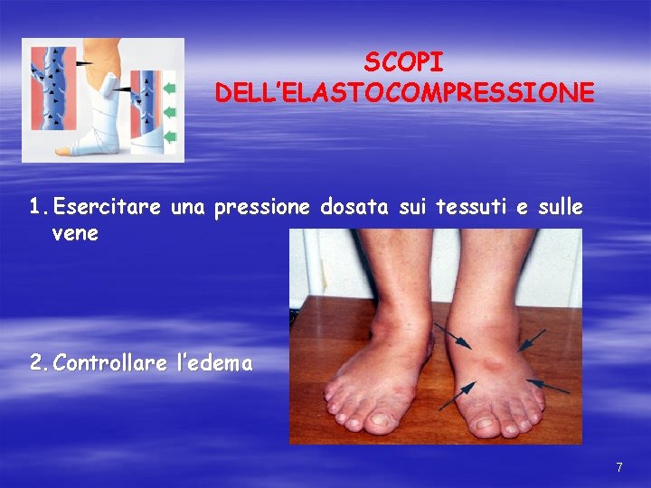 SCOPI DELL’ELASTOCOMPRESSIONE 1. Esercitare una pressione dosata sui tessuti e sulle vene 2. Controllare SCOPI DELL’ELASTOCOMPRESSIONE 1. Esercitare una pressione dosata sui tessuti e sulle vene 2. Controllare