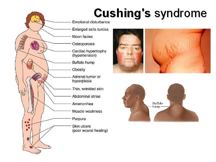 Cushing's syndrome 