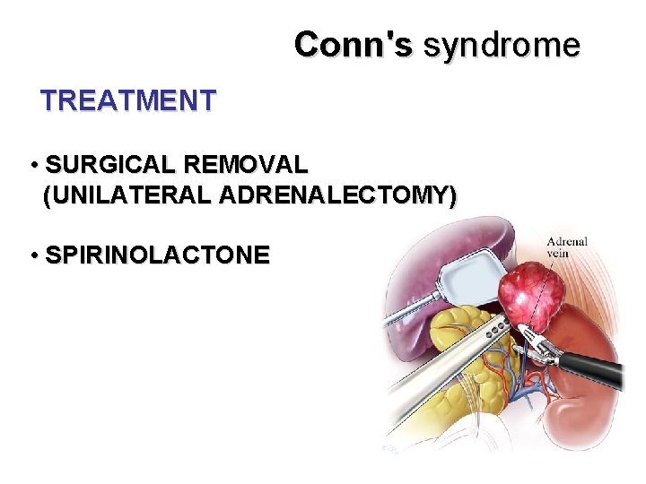 Conn's syndrome TREATMENT • SURGICAL REMOVAL (UNILATERAL ADRENALECTOMY) • SPIRINOLACTONE 