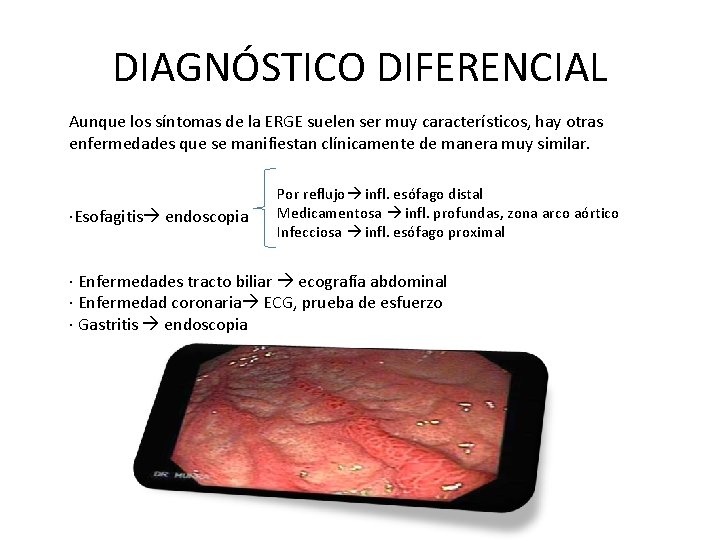 DIAGNÓSTICO DIFERENCIAL Aunque los síntomas de la ERGE suelen ser muy característicos, hay otras DIAGNÓSTICO DIFERENCIAL Aunque los síntomas de la ERGE suelen ser muy característicos, hay otras