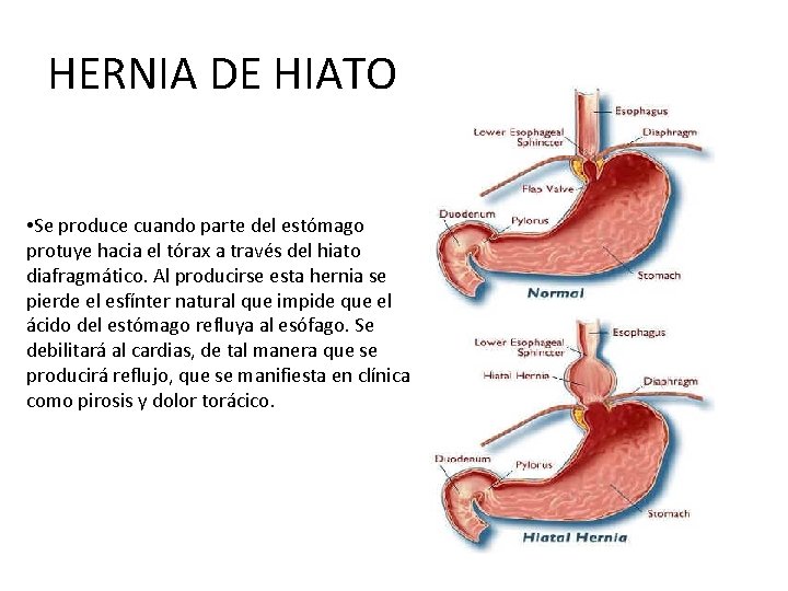 HERNIA DE HIATO • Se produce cuando parte del estómago protuye hacia el tórax HERNIA DE HIATO • Se produce cuando parte del estómago protuye hacia el tórax