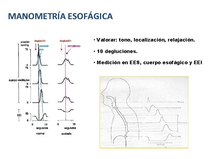 MANOMETRÍA ESOFÁGICA • Valorar: tono, localización, relajación. • 10 degluciones. • Medición en EES, MANOMETRÍA ESOFÁGICA • Valorar: tono, localización, relajación. • 10 degluciones. • Medición en EES,
