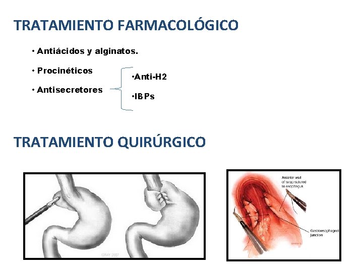 TRATAMIENTO FARMACOLÓGICO • Antiácidos y alginatos. • Procinéticos • Antisecretores • Anti-H 2 • TRATAMIENTO FARMACOLÓGICO • Antiácidos y alginatos. • Procinéticos • Antisecretores • Anti-H 2 •