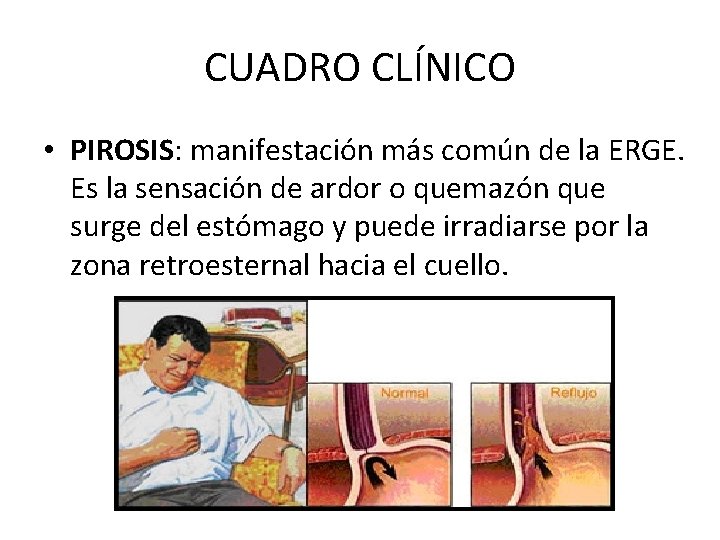CUADRO CLÍNICO • PIROSIS: manifestación más común de la ERGE. Es la sensación de CUADRO CLÍNICO • PIROSIS: manifestación más común de la ERGE. Es la sensación de