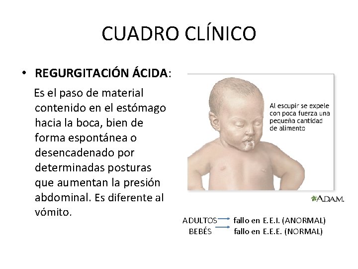 CUADRO CLÍNICO • REGURGITACIÓN ÁCIDA: Es el paso de material contenido en el estómago CUADRO CLÍNICO • REGURGITACIÓN ÁCIDA: Es el paso de material contenido en el estómago