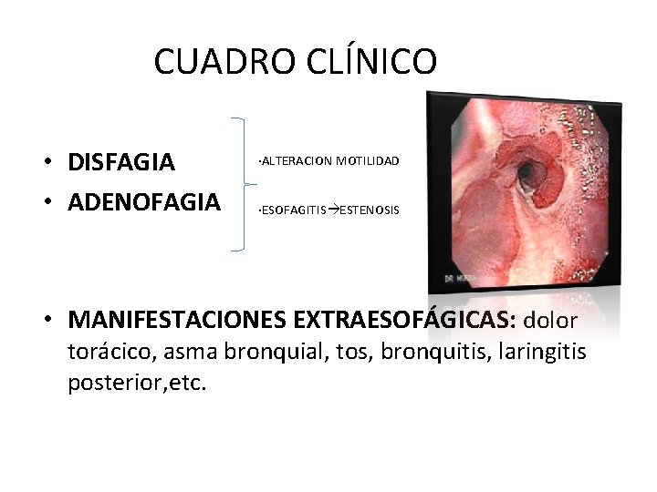 CUADRO CLÍNICO • DISFAGIA • ADENOFAGIA ·ALTERACION MOTILIDAD ·ESOFAGITIS ESTENOSIS • MANIFESTACIONES EXTRAESOFÁGICAS: dolor CUADRO CLÍNICO • DISFAGIA • ADENOFAGIA ·ALTERACION MOTILIDAD ·ESOFAGITIS ESTENOSIS • MANIFESTACIONES EXTRAESOFÁGICAS: dolor