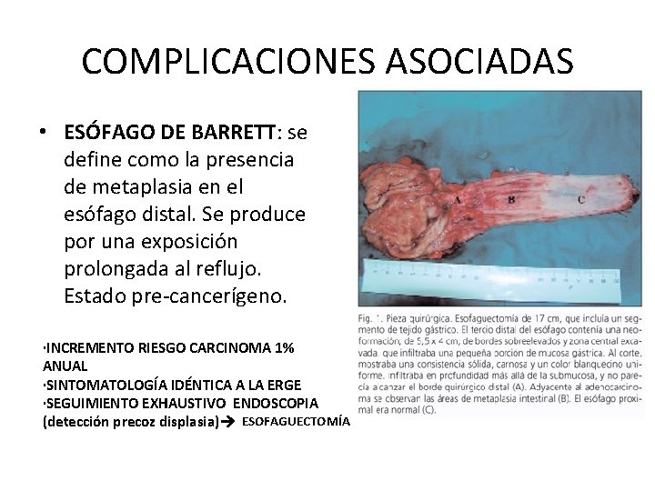 COMPLICACIONES ASOCIADAS • ESÓFAGO DE BARRETT: se define como la presencia de metaplasia en COMPLICACIONES ASOCIADAS • ESÓFAGO DE BARRETT: se define como la presencia de metaplasia en