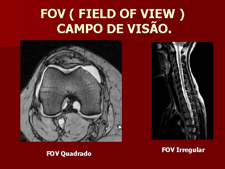 FOV ( FIELD OF VIEW ) CAMPO DE VISÃO. FOV Quadrado FOV Irregular 