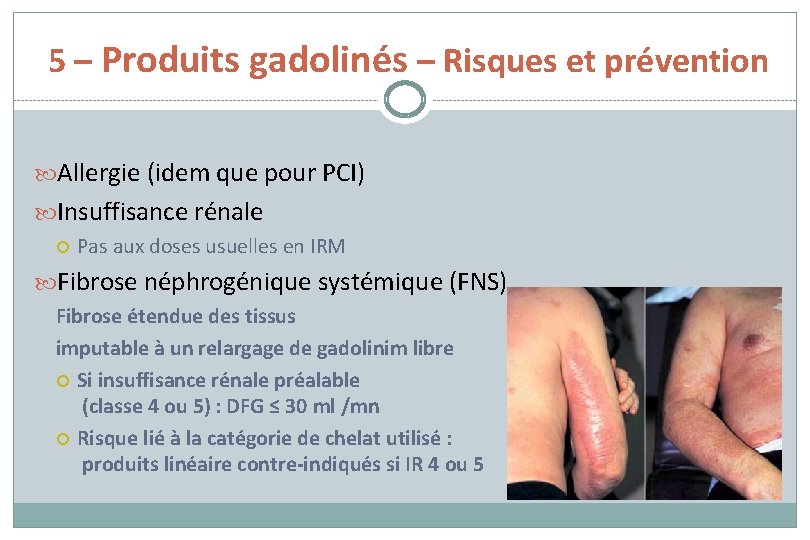 5 – Produits gadolinés – Risques et prévention Allergie (idem que pour PCI) Insuffisance