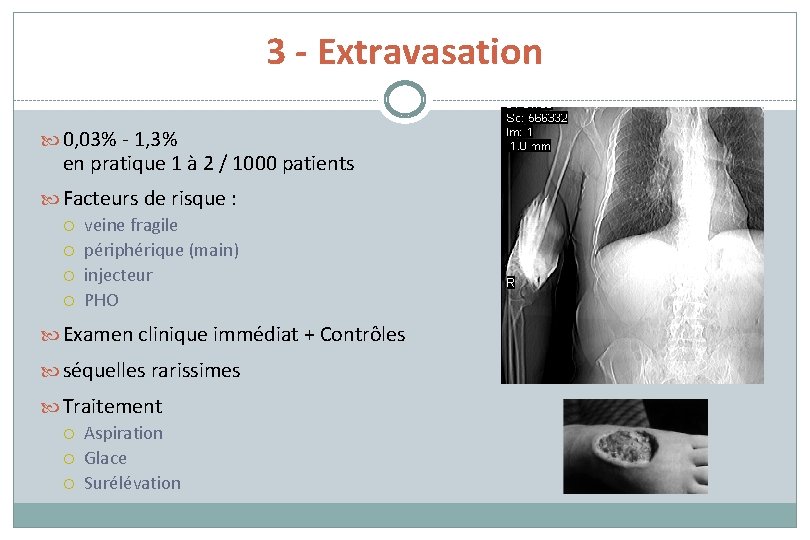 3 - Extravasation 0, 03% - 1, 3% en pratique 1 à 2 /