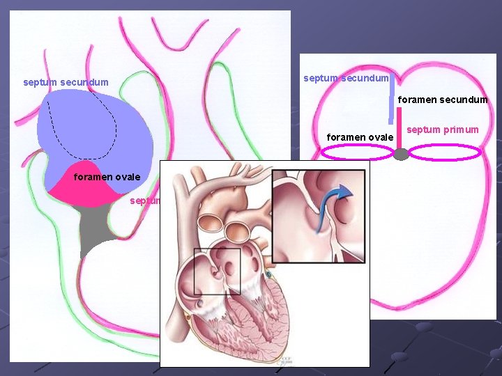 septum secundum foramen ovale septum primum 