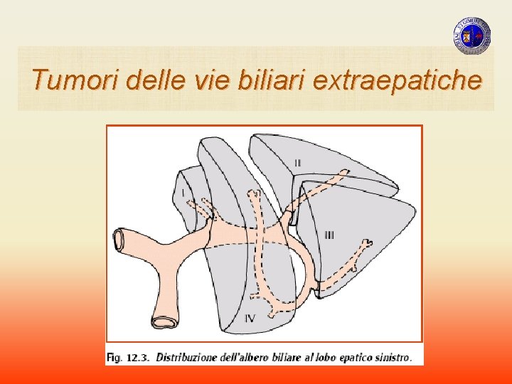 Tumori delle vie biliari extraepatiche Tumori delle vie biliari extraepatiche