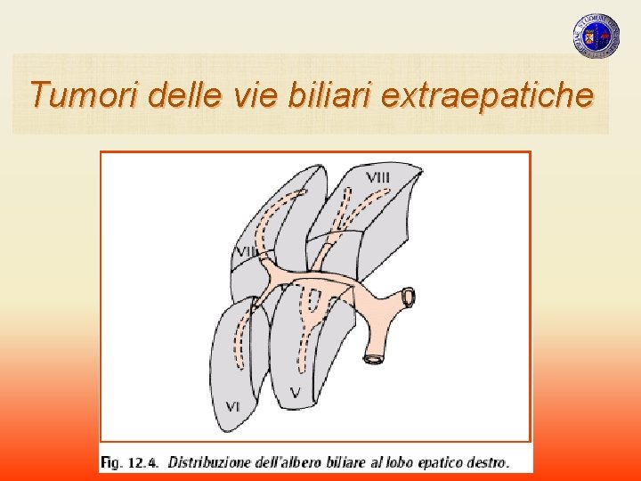 Tumori delle vie biliari extraepatiche Tumori delle vie biliari extraepatiche