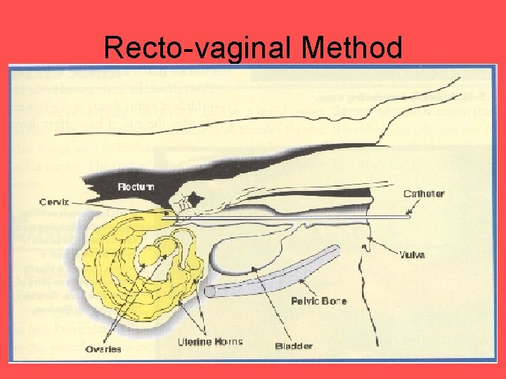 Recto-vaginal Method 