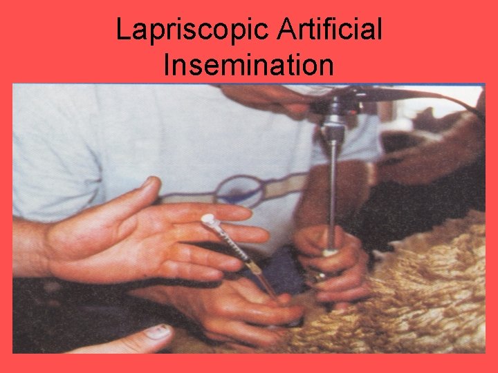 Lapriscopic Artificial Insemination 